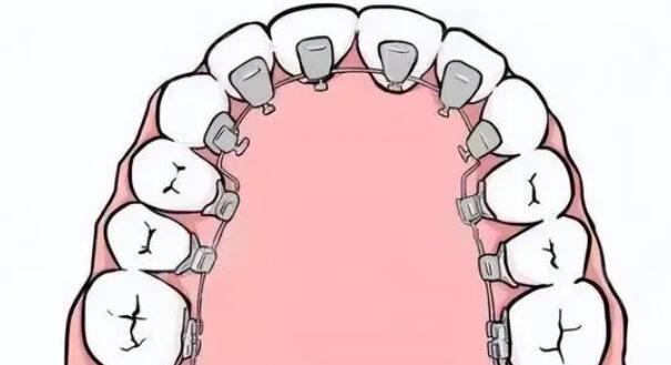 龋齿的传染性以及根管治疗的重要性。