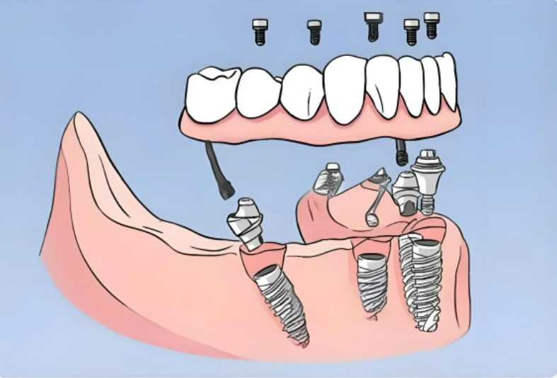 深入了解半固定种植牙特点以及治疗过程