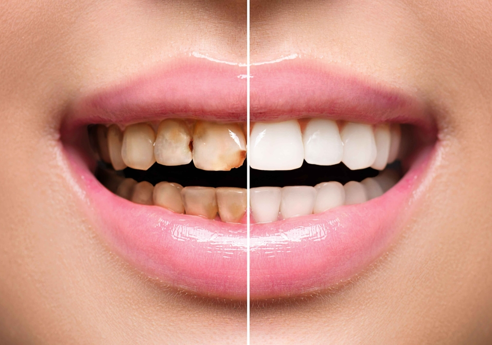 牙齿黑色污垢怎么去除？有什么方法？