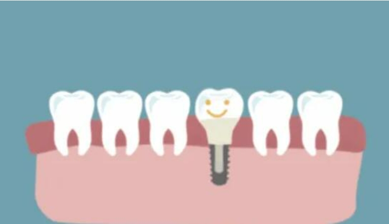种植牙和镶牙哪个更舒适？