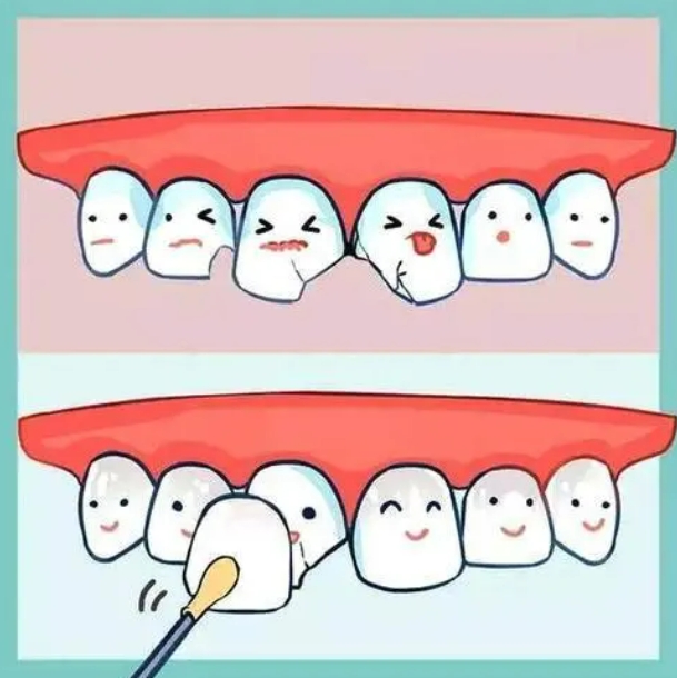 牙齿断裂修复