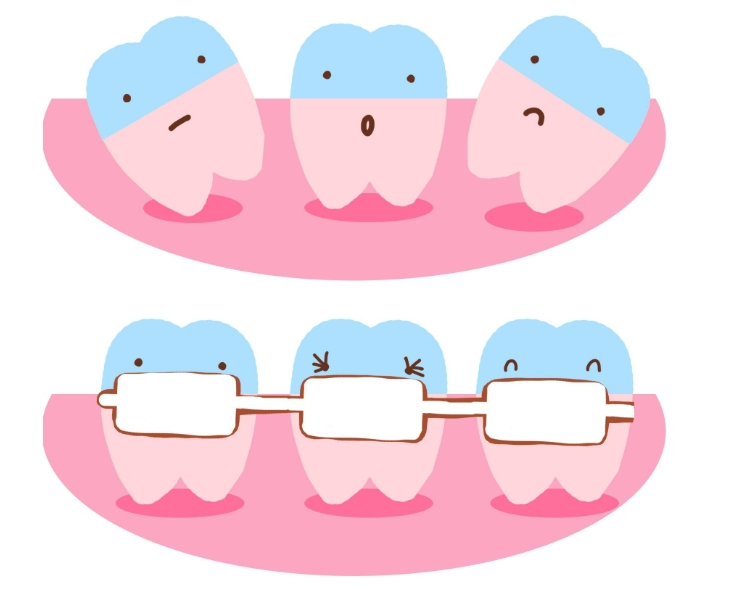 有效的牙齿矫正方法是哪种?