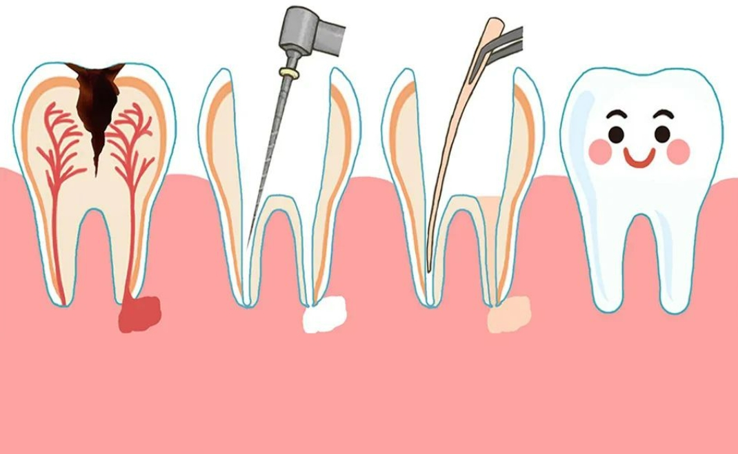 牙齿疼为什么医生建议先根管治疗，而不是补牙？