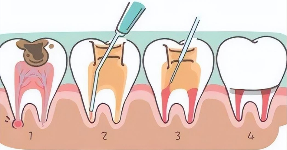 根管治疗后必须做牙套吗？