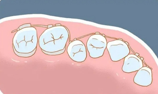 牙齿拥挤不拔牙可以矫正吗？