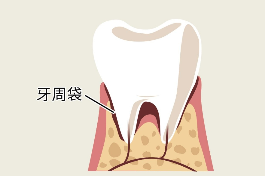 牙周袋怎么回事,用哪种方法治疗？