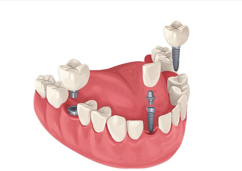 活动假牙和种植牙:如何根据自身条件做出明智选择?